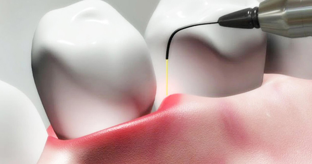 Laser Assisted Treatments