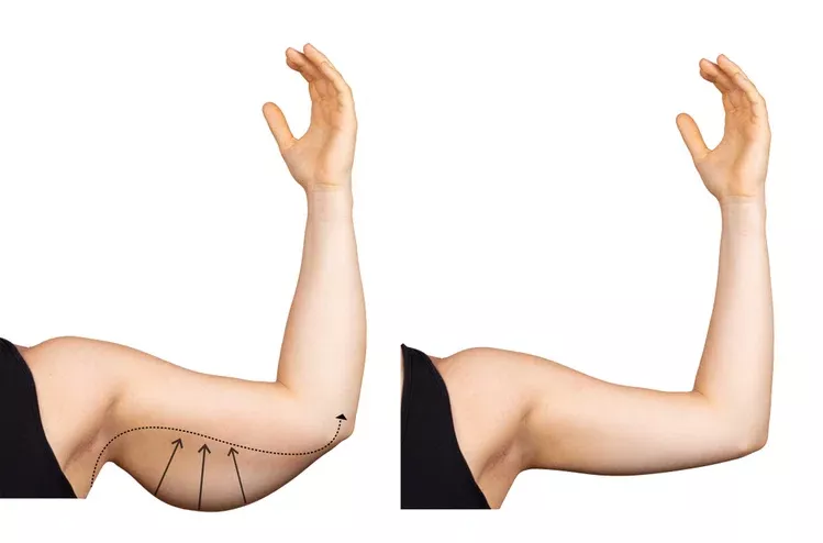 Arm Aesthetics