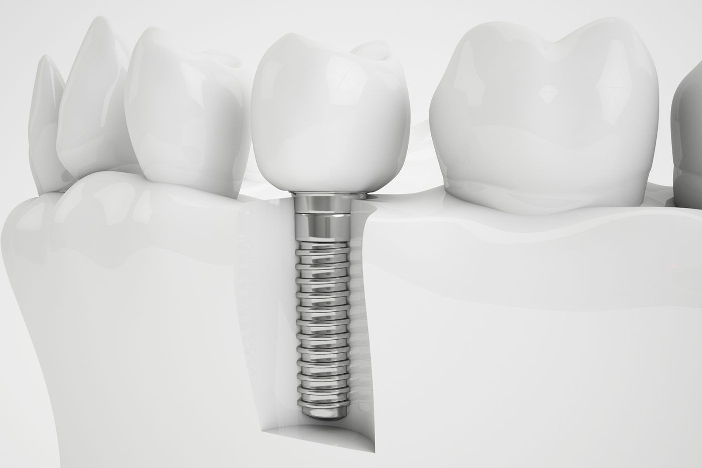Implant
