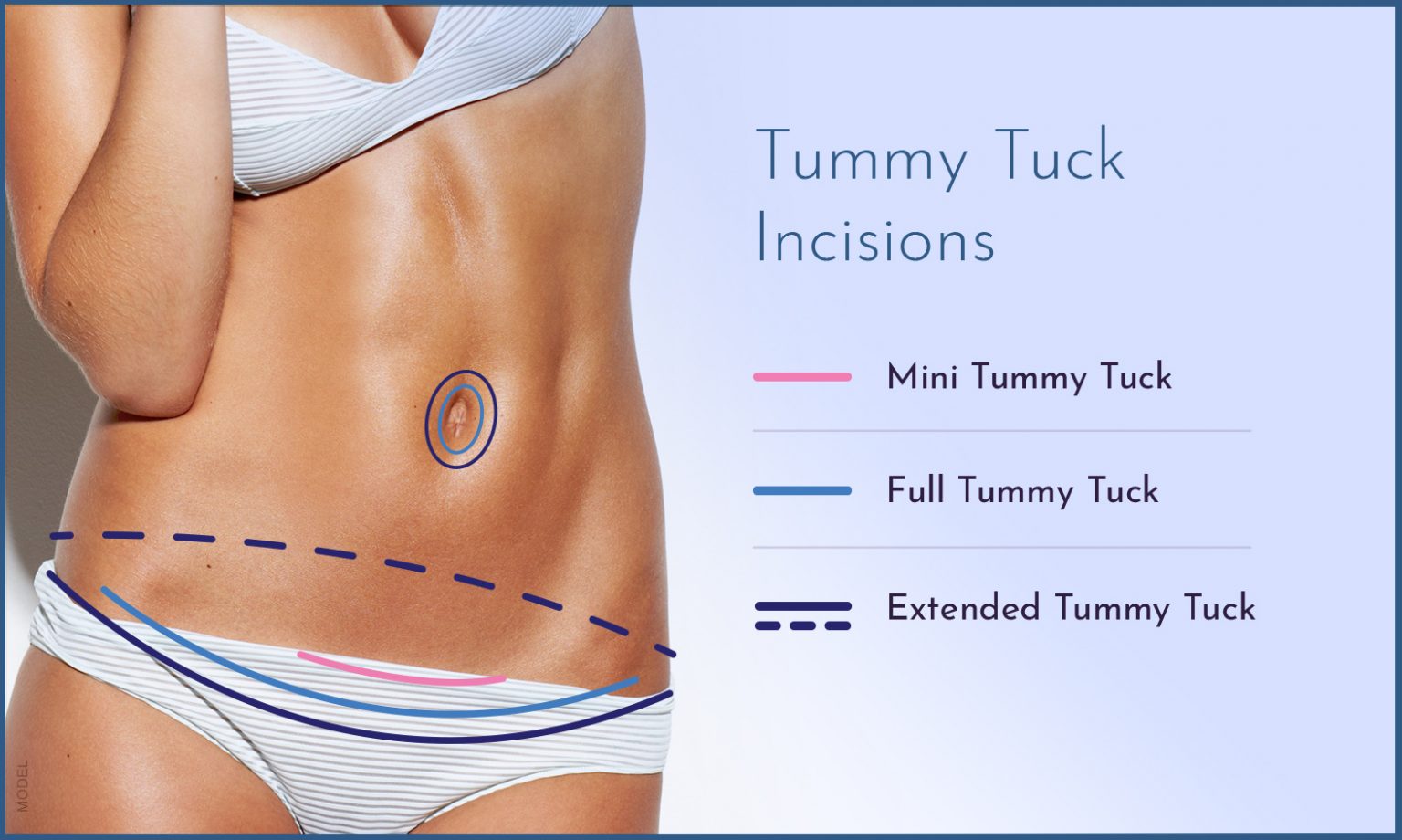 Tummy Tuck