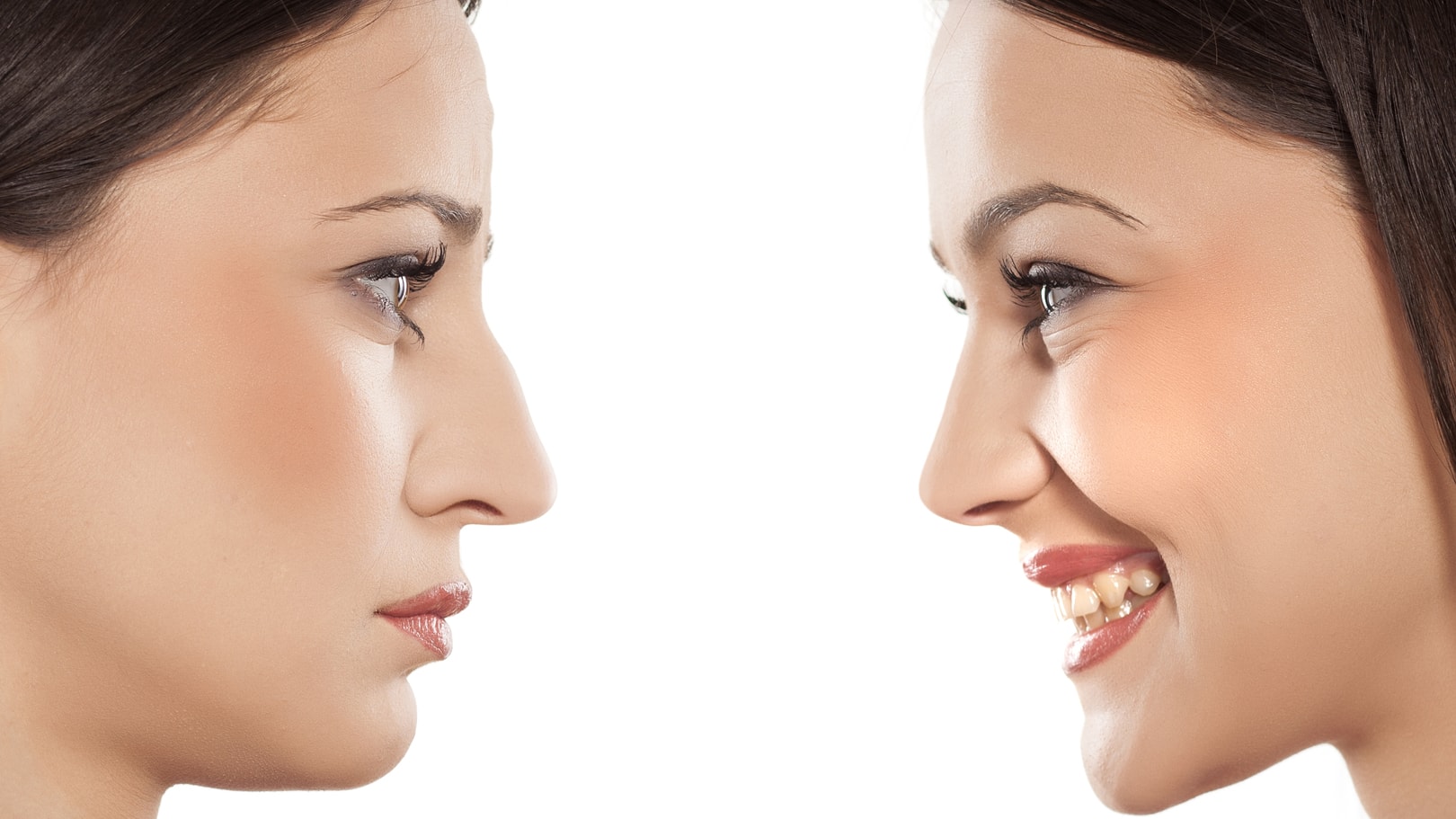 Rhinoplasty