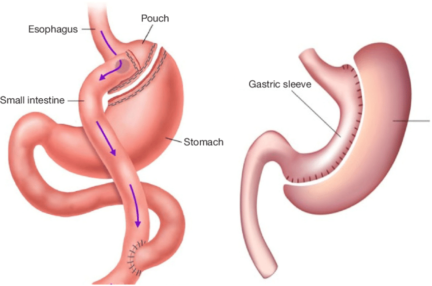 RNY Gastric Bypass