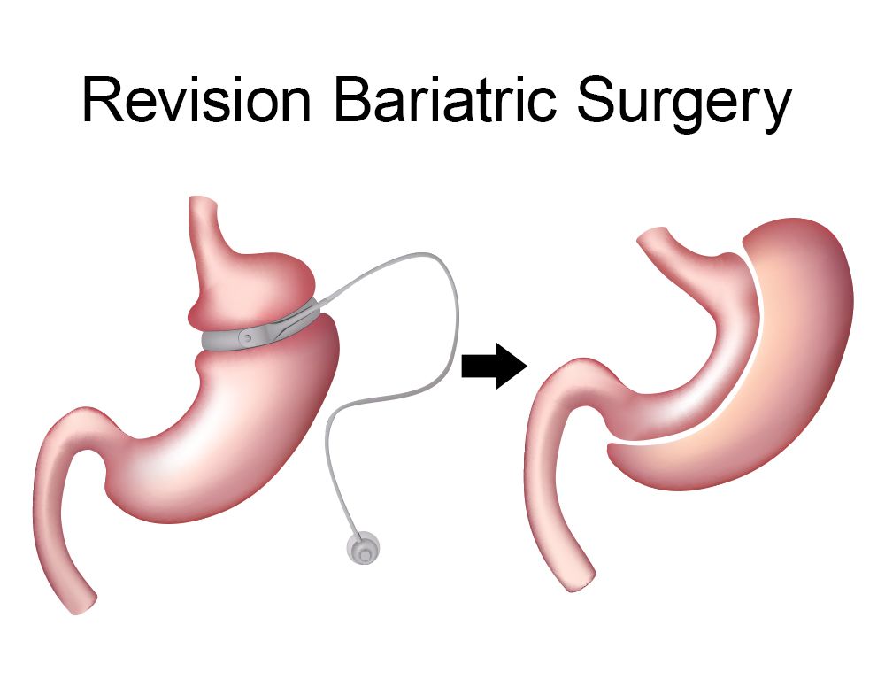 Revisional Surgery