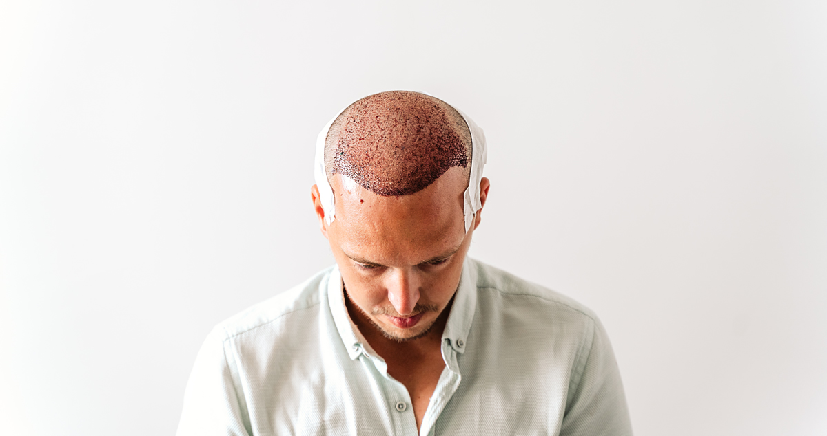 What is Hair Transplantation?