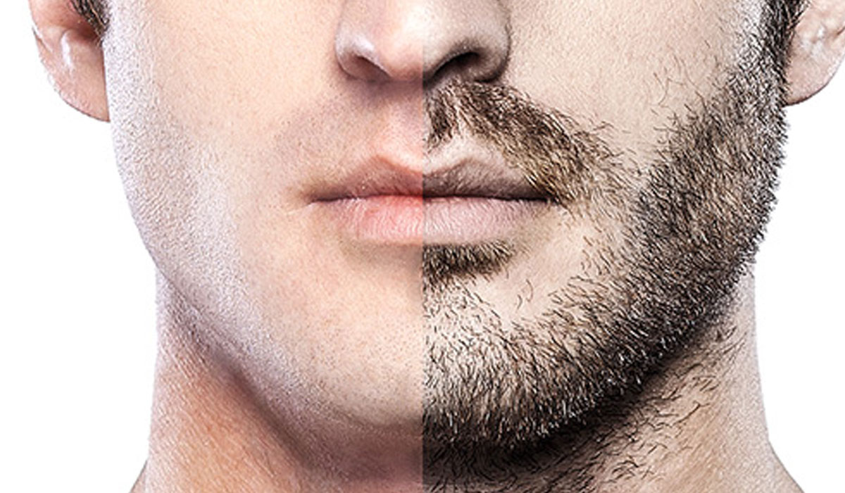 Mustache Transplantation
