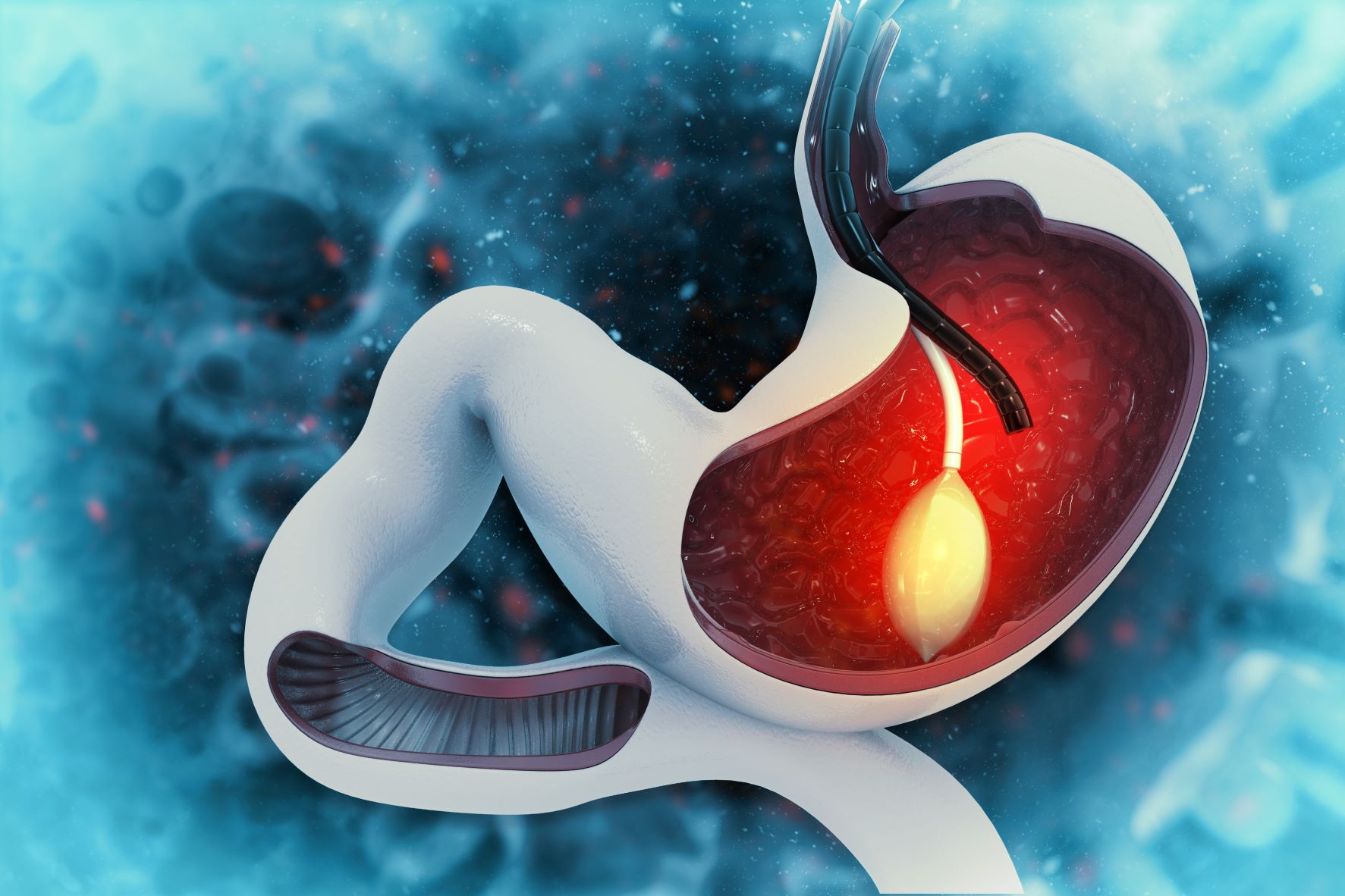 Endoscopic 6 Month Gastric Balloon
