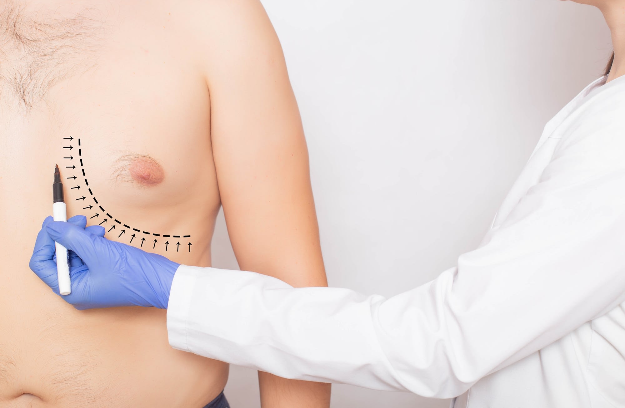Gynecomastia