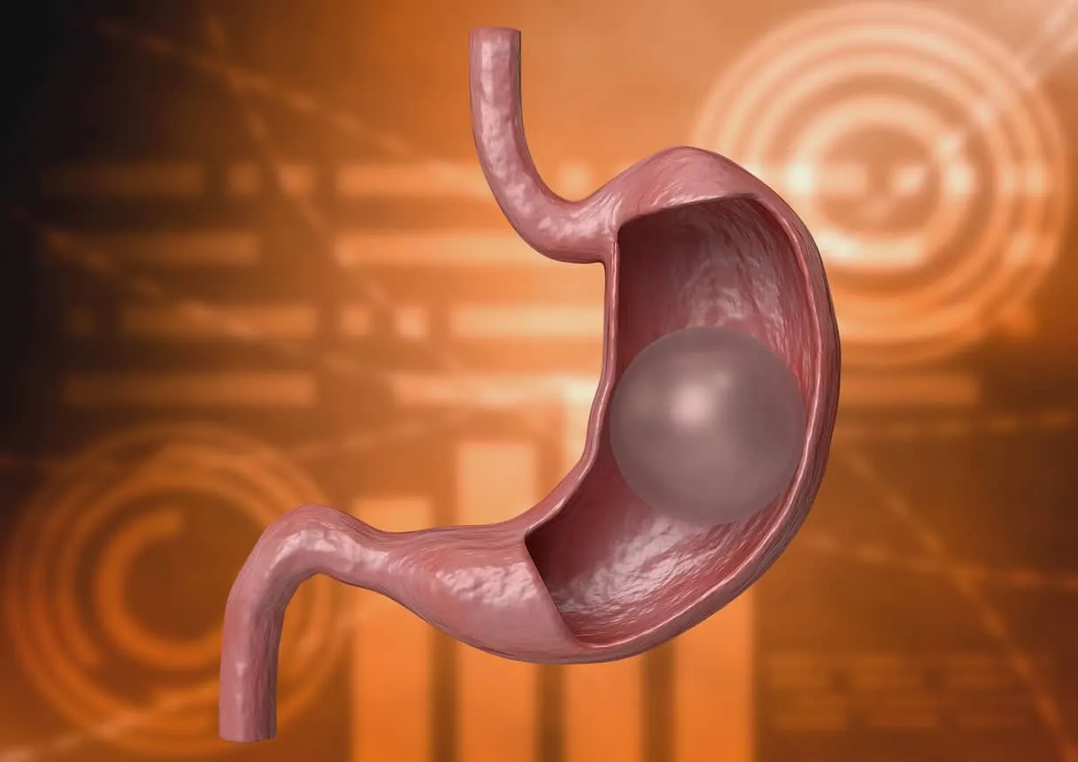 Gastric Balloon