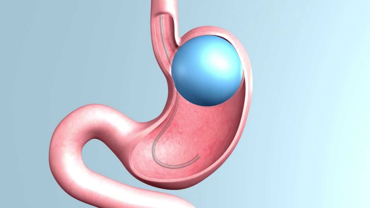 Endoscopic (Adjustable) 12 Month Gastric Balloon